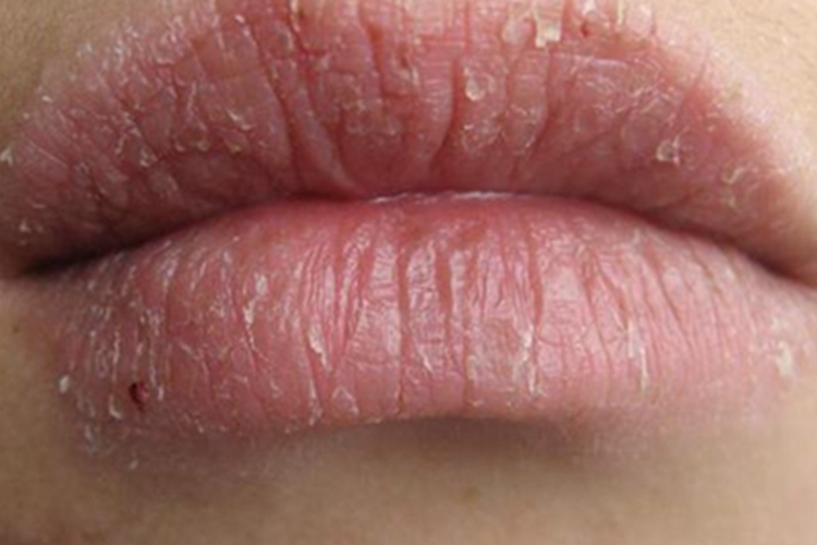 慢性光化性唇炎嘴唇脱屑图 慢性光化性唇炎嘴唇脱屑图
