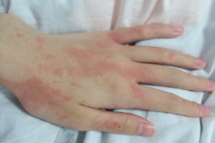 振动性荨麻疹手背红斑图