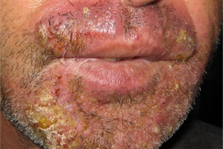 狼疮样须疮下巴结痂症状图 狼疮样须疮下巴结痂症状图