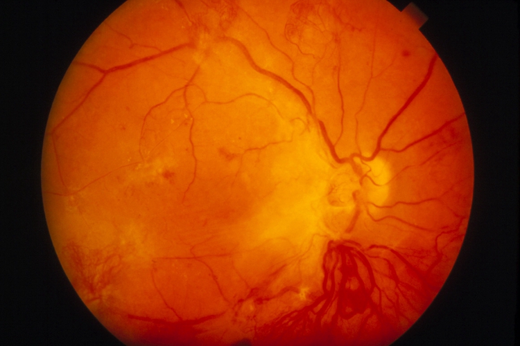 增殖型糖尿病性视网膜病变图