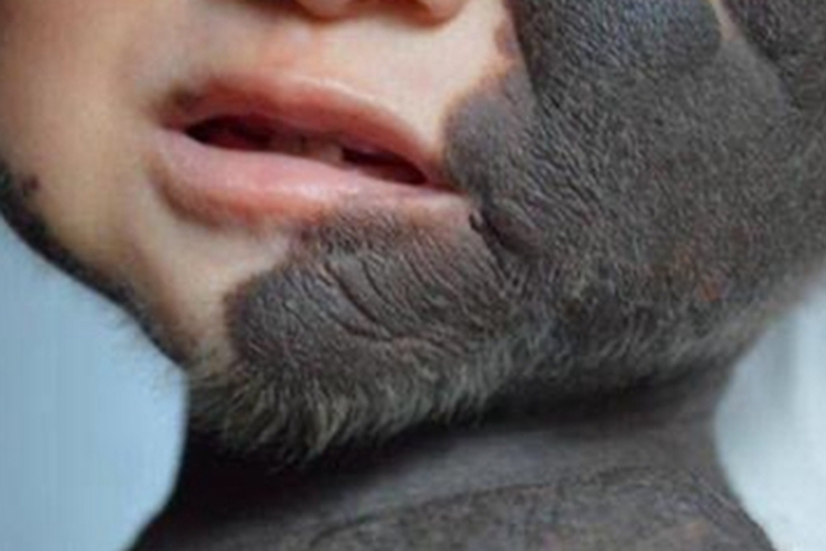 兽皮痣面部黑痣图