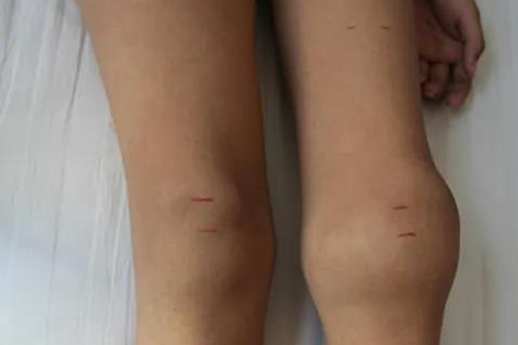 血友病膝关节肿胀图