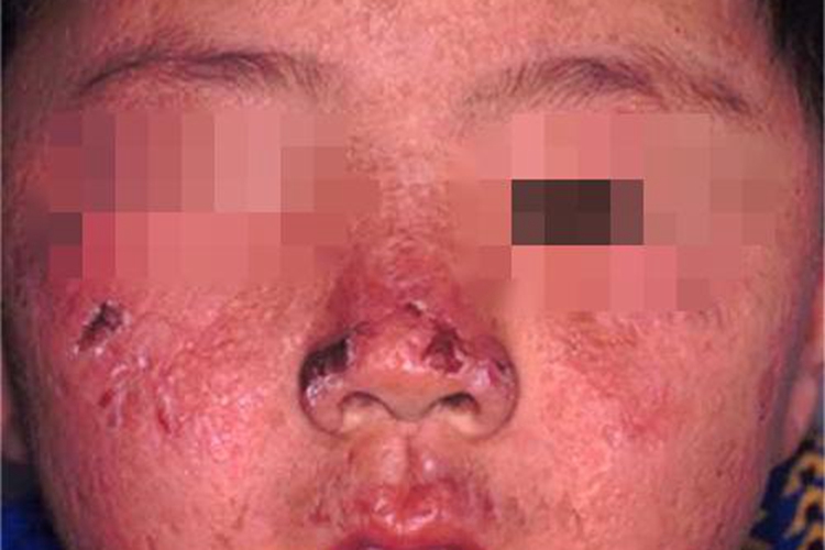 卟啉病面部黑痂图