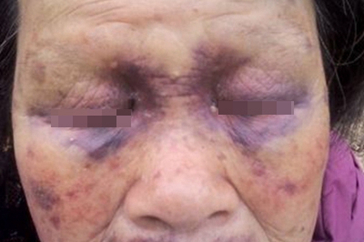 血小板减少性紫癜症状图