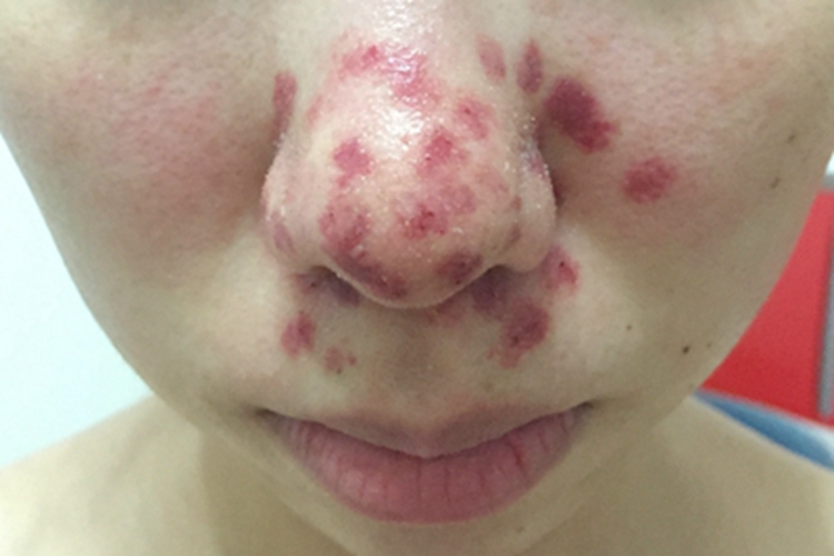 组织胞浆菌病鼻部症状图 组织胞浆菌病鼻部症状图