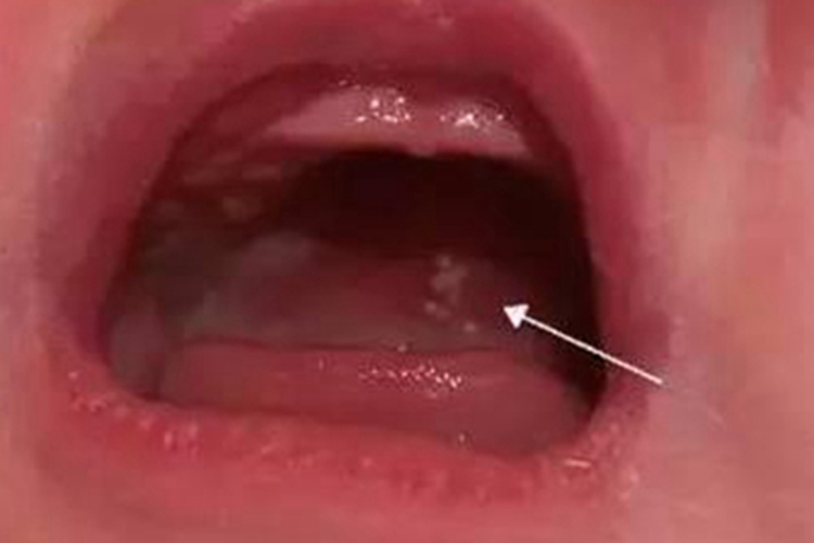 马牙口腔小疙瘩图 马牙口腔小疙瘩图