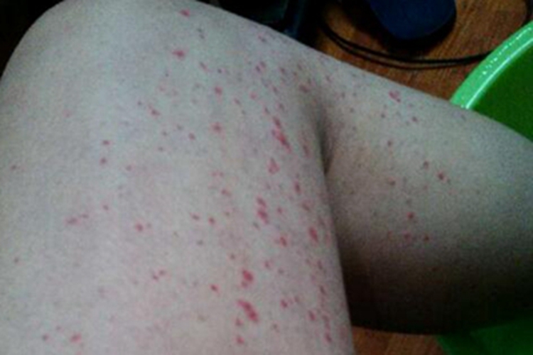 皮下出血腿部血点图 皮下出血腿部血点图