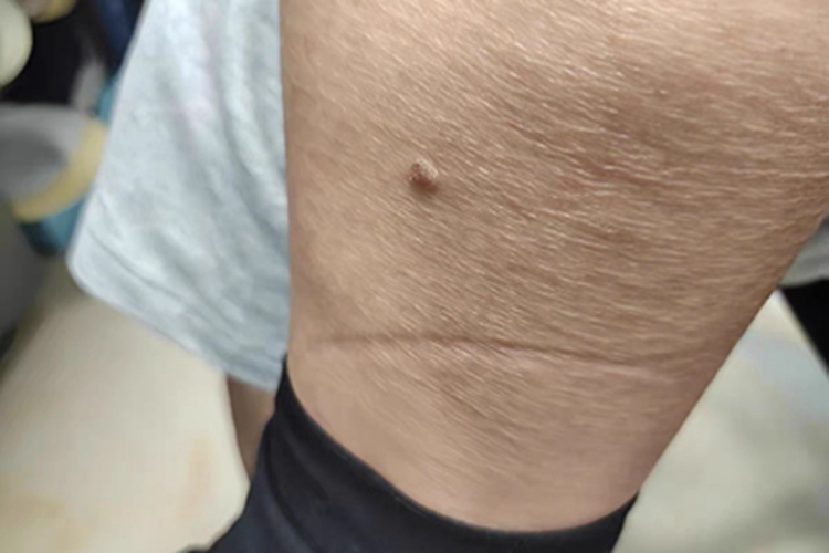 寻常疣小腿疙瘩图