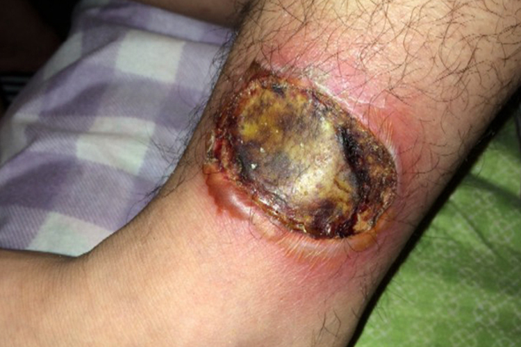 小腿烫伤Ⅲ度创口焦炭化图