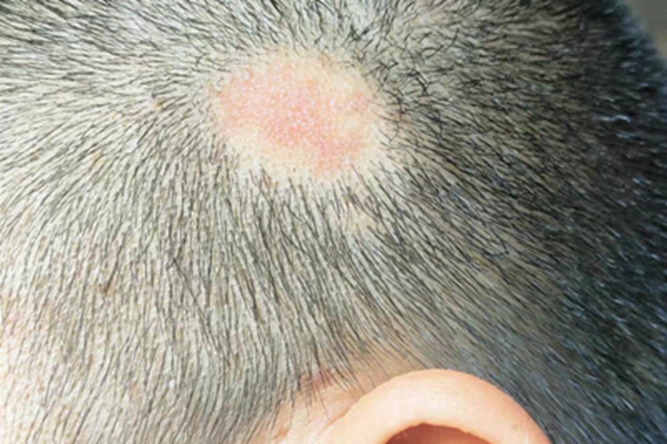 进展期斑秃头皮脱发有红斑图 进展期斑秃头皮脱发有红斑图