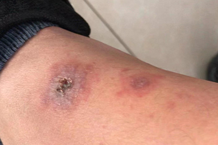 多形红斑胳膊皮肤结痂图 多形红斑胳膊皮肤结痂图