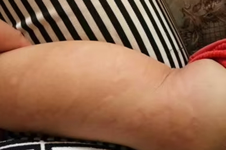 新生儿红斑小腿上有风团图
