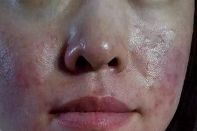 青年成人期特应性皮炎面部症状图 青年成人期特应性皮炎面部症状图