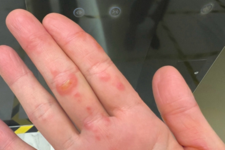 重症多形红斑手部水疱图 重症多形红斑手部水疱图