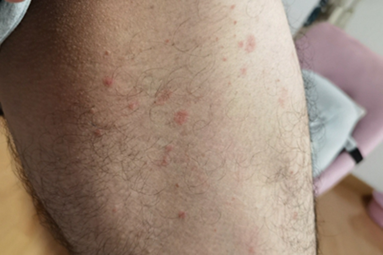 荨麻疹小红疙瘩图