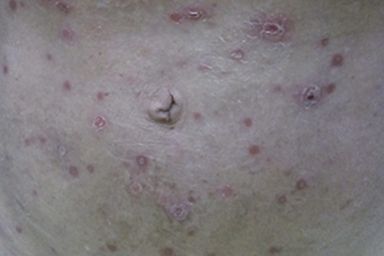 女性梅毒腹部症状图