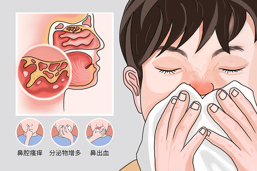 鼻黏膜溃疡是什么病-有来医生