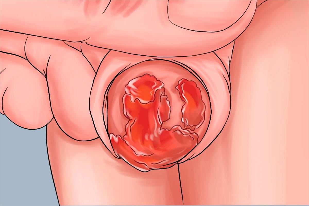 浆细胞性龟头炎疙瘩手绘图