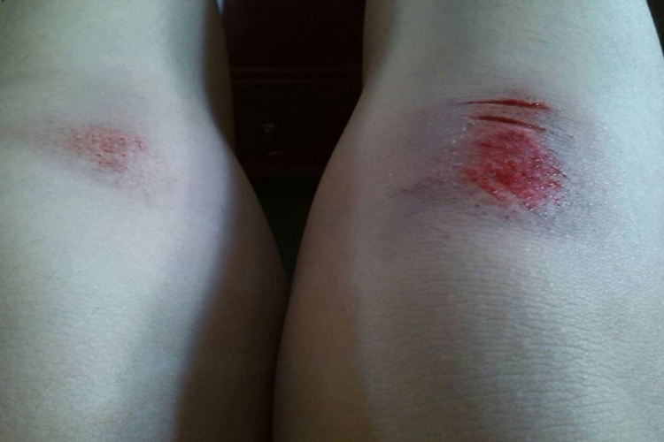 膝盖摔伤出血图 膝盖摔伤出血图