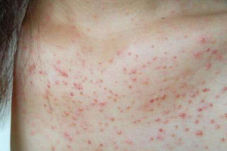 毛囊炎胸前红色小痘痘图