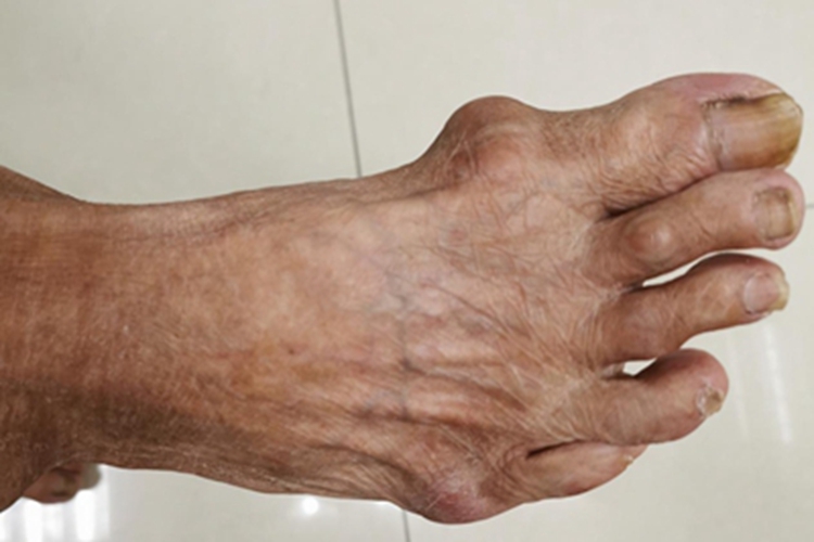 痛风脚部赘生物图 痛风脚部赘生物图