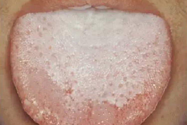 前剥苔图 前剥苔图