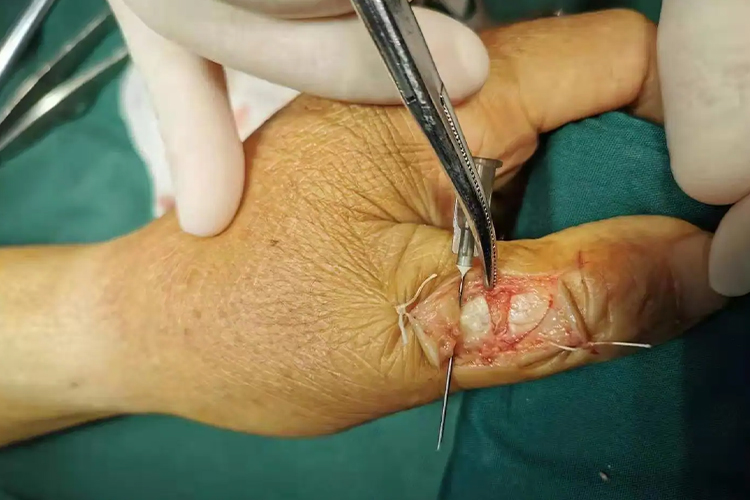 手指伸指肌腱断裂图