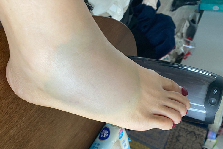 右骰骨骨折脚背肿胀皮肤青紫图 右骰骨骨折脚背肿胀皮肤青紫图