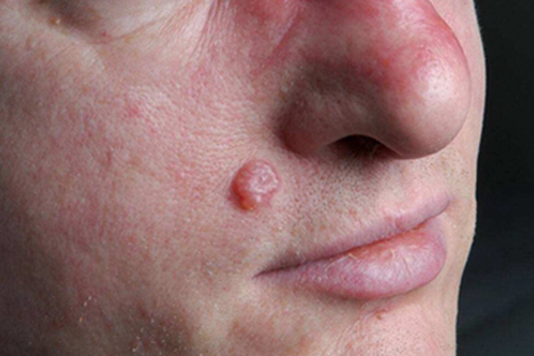 结节型基底细胞癌面部结节图 结节型基底细胞癌面部结节图