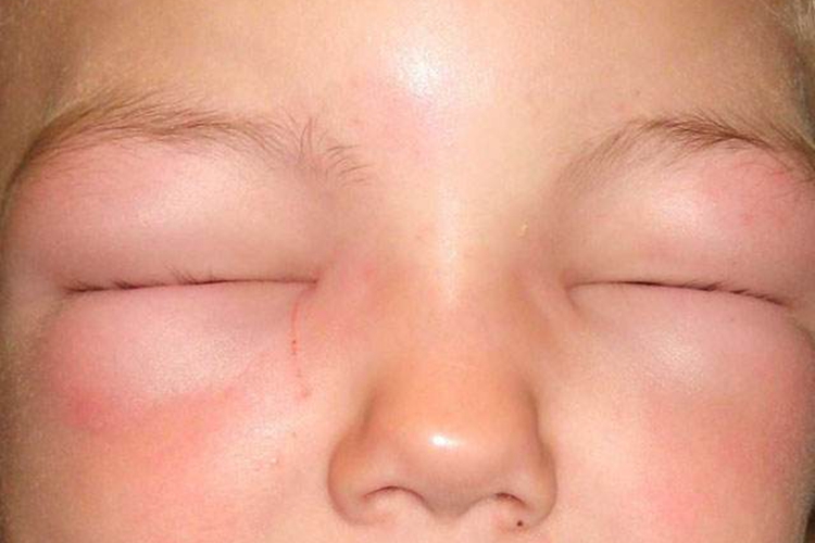 急性肾小球肾炎眼睑浮肿图