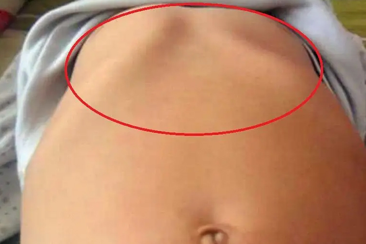 儿童鸡胸骨突出图