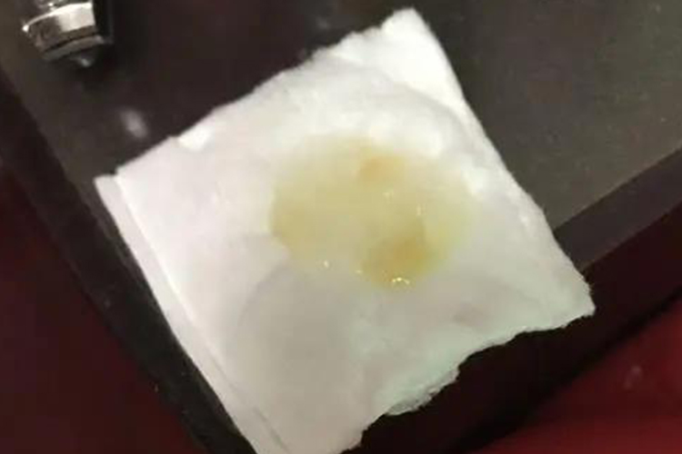 肺炎咳出小坨凝固的痰图