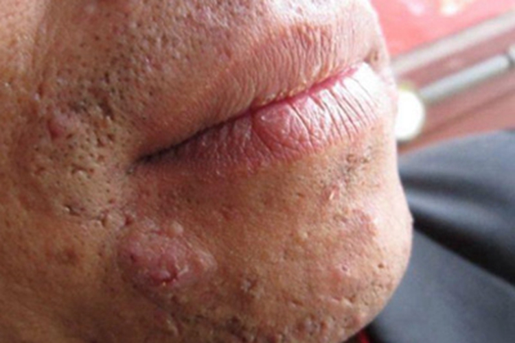 狼疮样须疮下巴皮肤粗糙图