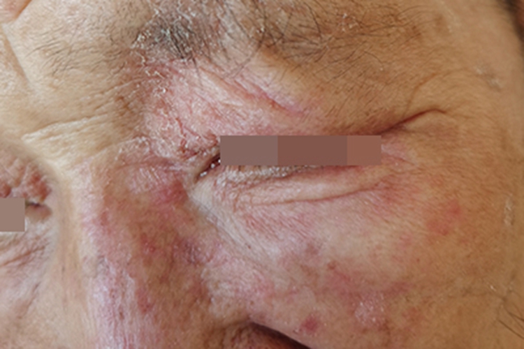 体癣面部发红脱皮图 体癣面部发红脱皮图