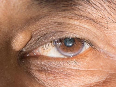 角膜老年环图片图片