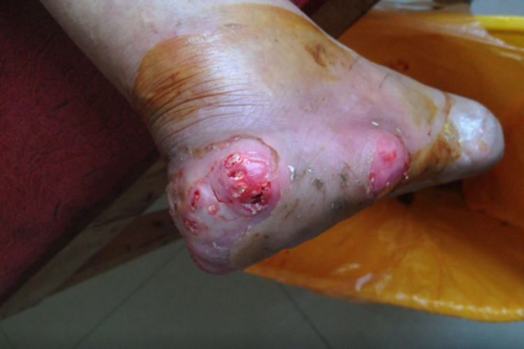 痛风石足跟伤口破溃图