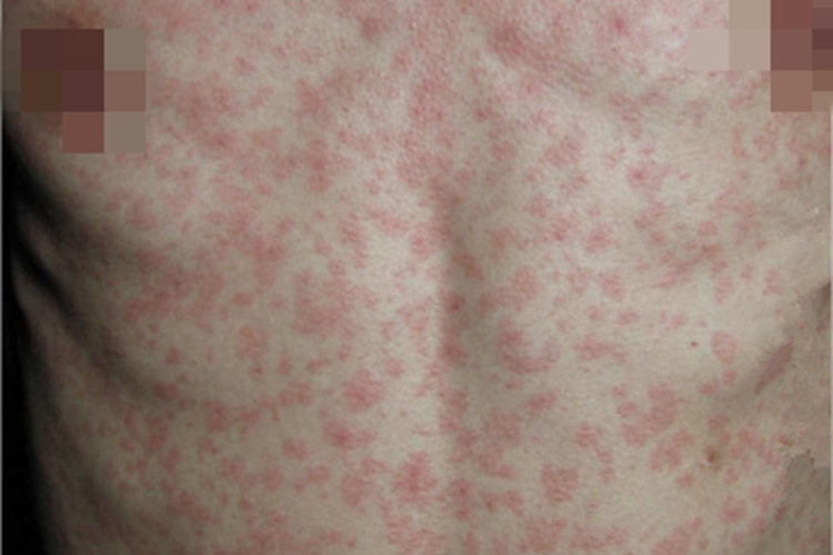 猩红热型药疹腹部红斑图