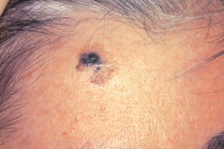 恶性雀斑样痣前额症状图 恶性雀斑样痣前额症状图