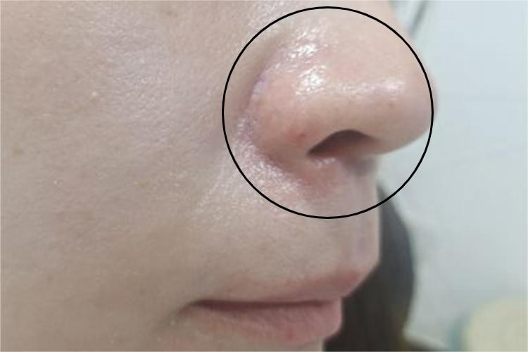 成人脂溢性皮炎鼻翼疙瘩图 成人脂溢性皮炎鼻翼疙瘩图