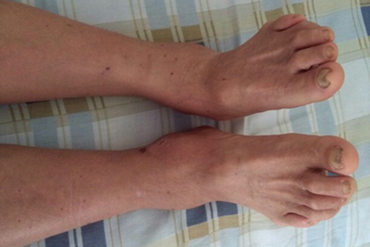 结节性液化性脂膜炎踝关节肿大图 结节性液化性脂膜炎踝关节肿大图