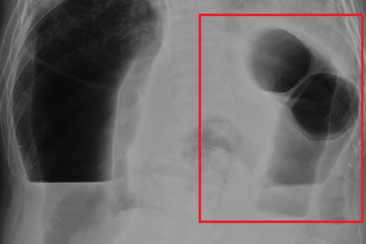 结肠梗阻DR影像图