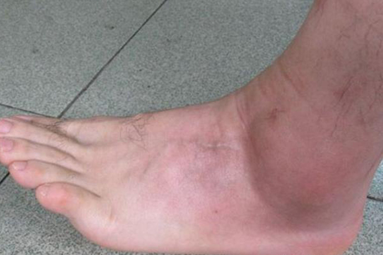 痛风性关节炎疼痛肿胀图