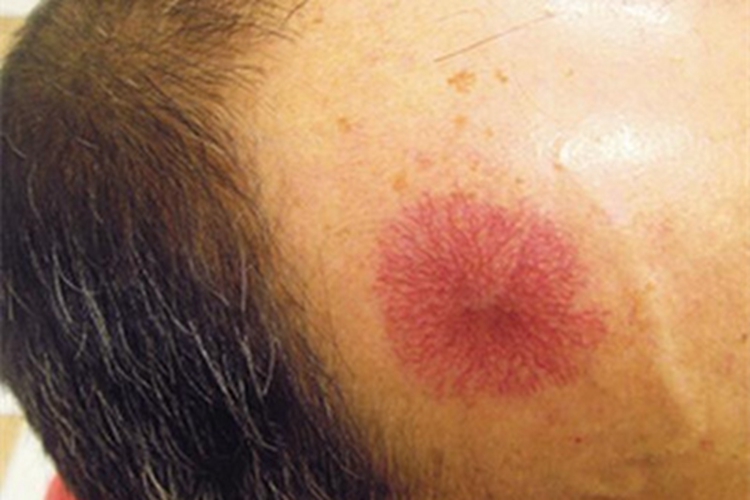 蜘蛛状毛细血管扩张症前额红斑图