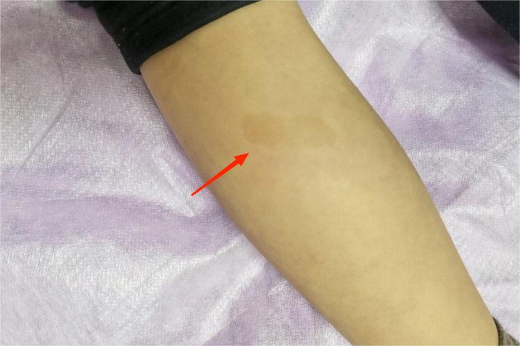 小腿长咖啡斑的图