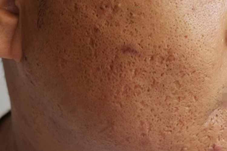 痤疮脸上全是坑图