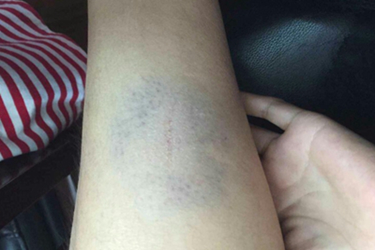 挫伤小腿紫了一大块图