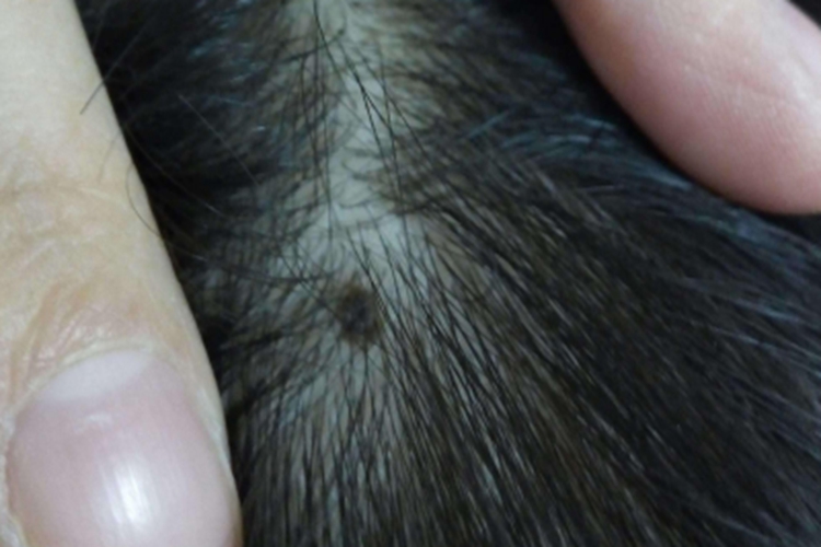 复合痣头皮上有一个痣图 复合痣头皮上有一个痣图