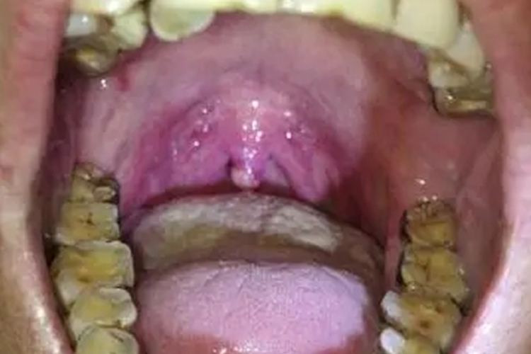 悬雍垂乳头状瘤真实图 悬雍垂乳头状瘤真实图