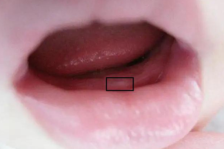 婴儿乳牙萌出初期图