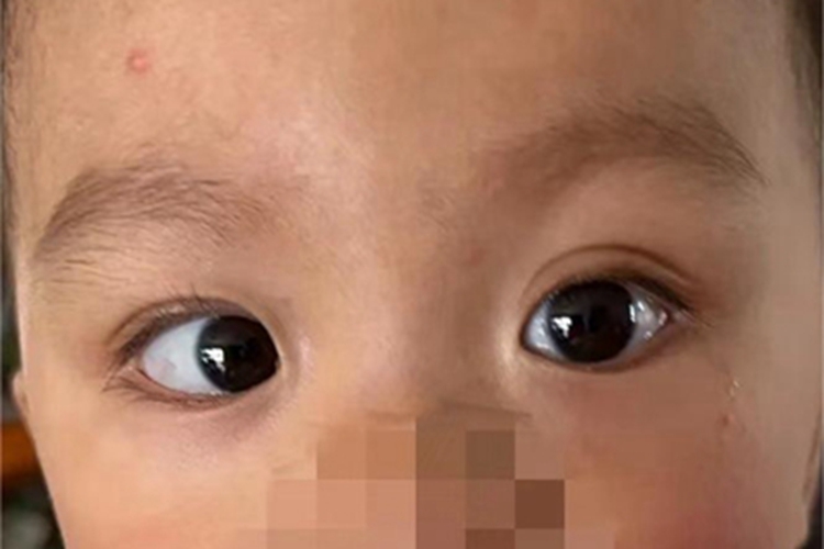 先天性内斜视眼球位置不对称图 先天性内斜视眼球位置不对称图